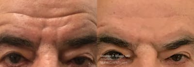 Forehead Line (Botox) Before & After Gallery - Patient 203911 - Image 1