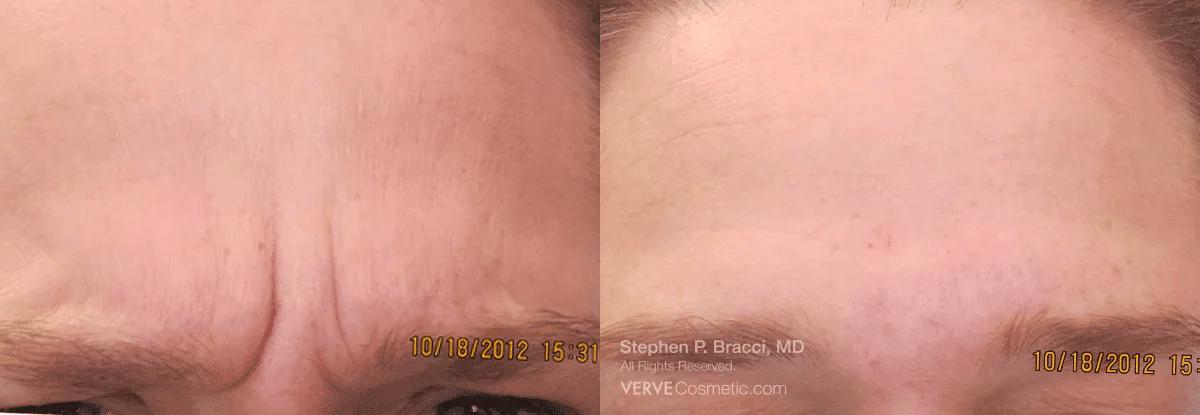 11 Lines (Botox) Before & After Gallery - Patient 238506 - Image 1