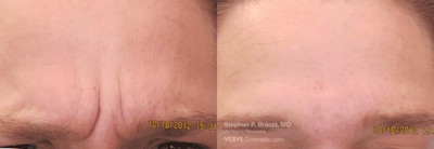 11 Lines (Botox) Before & After Gallery - Patient 238506 - Image 1