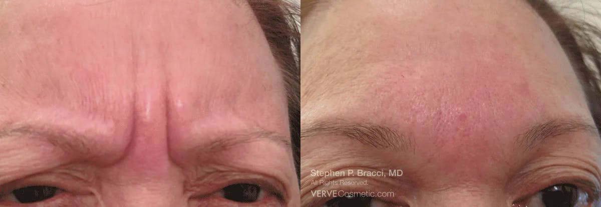 11 Lines (Botox) Before & After Gallery - Patient 177191 - Image 1