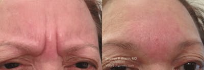 11 Lines (Botox) Before & After Gallery - Patient 177191 - Image 1
