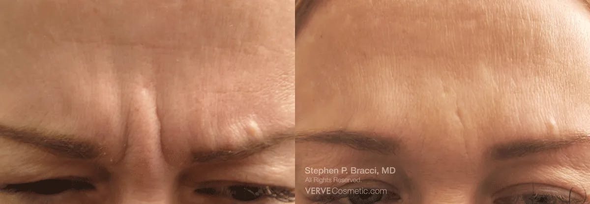 11 Lines (Botox) Before & After Gallery - Patient 376612 - Image 1