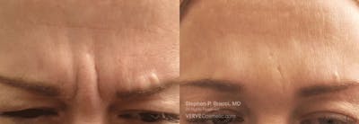 11 Lines (Botox) Before & After Gallery - Patient 376612 - Image 1