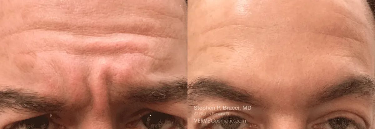 11 Lines (Botox) Before & After Gallery - Patient 271740 - Image 1