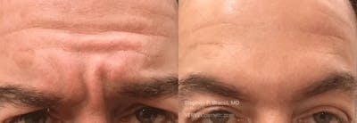 11 Lines (Botox) Before & After Gallery - Patient 271740 - Image 1
