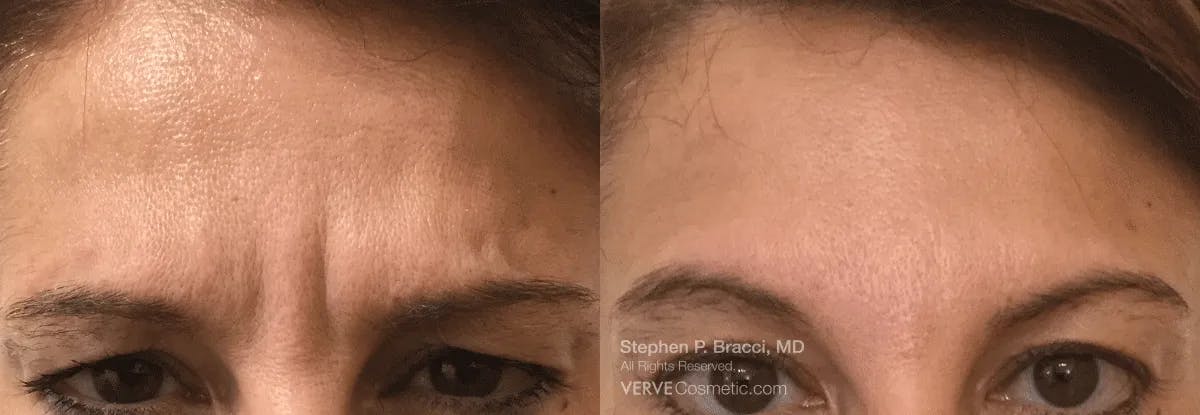 11 Lines (Botox) Before & After Gallery - Patient 179564 - Image 1