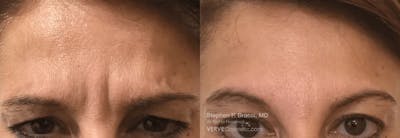 11 Lines (Botox) Before & After Gallery - Patient 179564 - Image 1