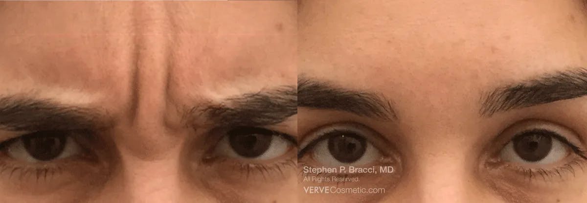 11 Lines (Botox) Before & After Gallery - Patient 199352 - Image 1