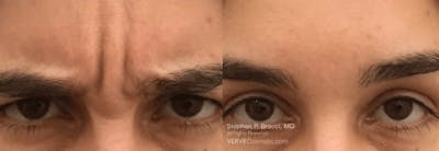 11 Lines (Botox) Before & After Gallery - Patient 199352 - Image 1