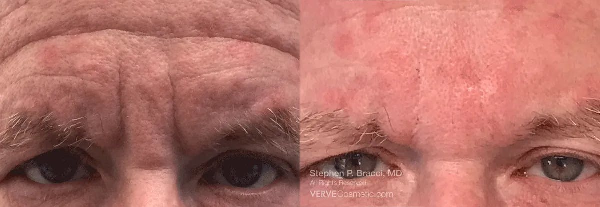 11 Lines (Botox) Before & After Gallery - Patient 109206 - Image 1