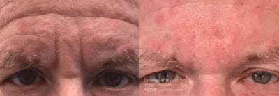 11 Lines (Botox) Before & After Gallery - Patient 109206 - Image 1