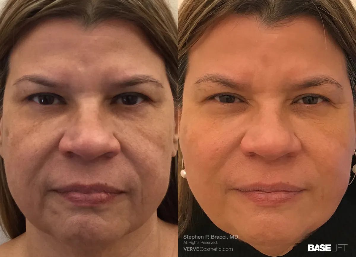 Baselift™ Before & After Gallery - Patient 145053 - Image 1