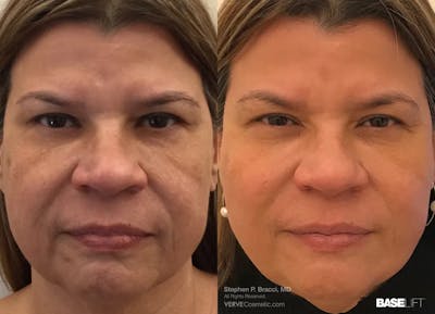 Baselift™ Before & After Gallery - Patient 145053 - Image 1