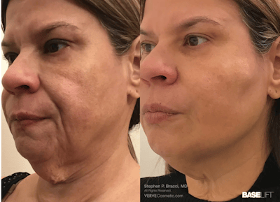 Chin Fat Before & After Gallery - Patient 427664 - Image 1