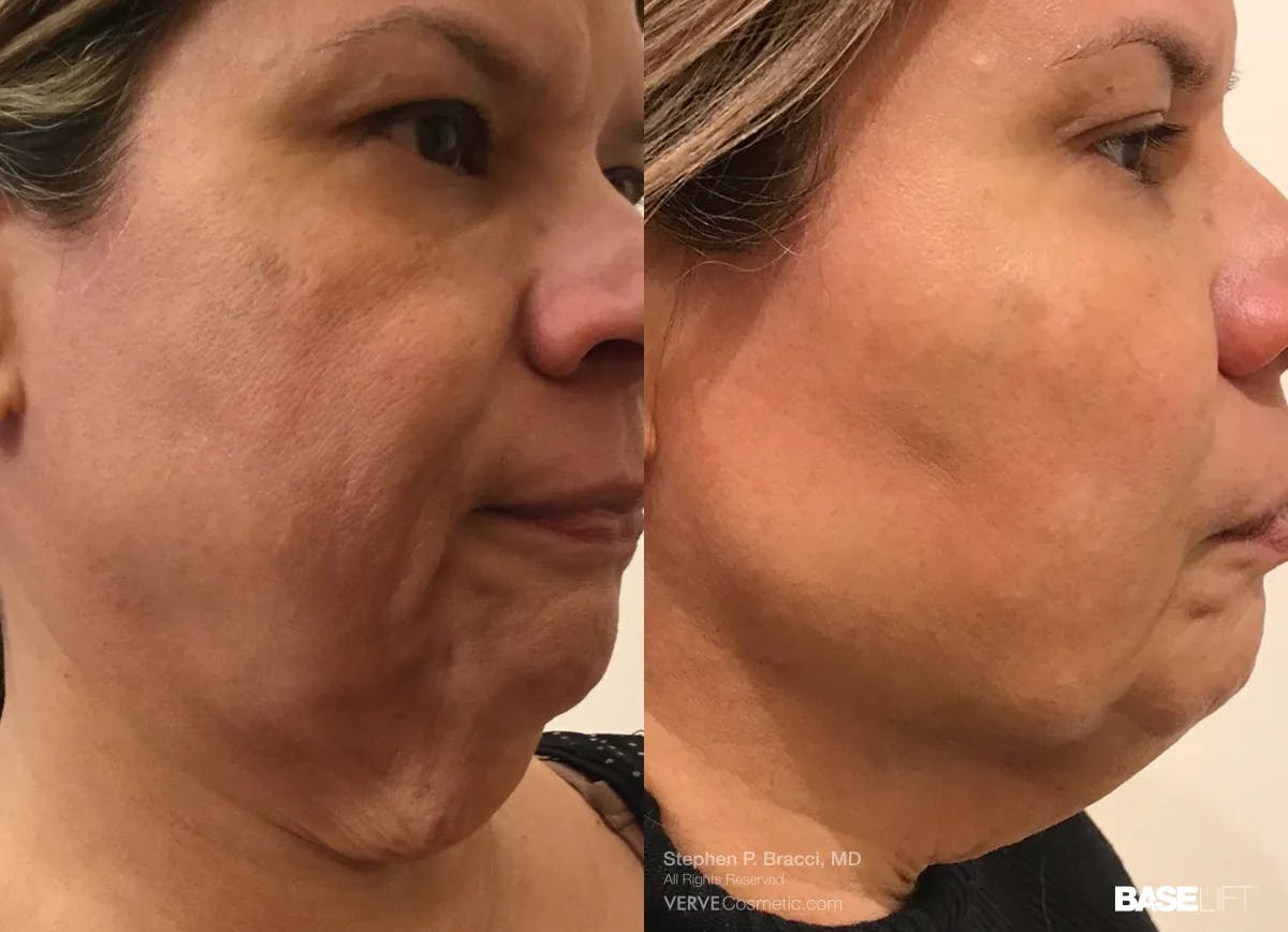 Baselift™ Before & After Gallery - Patient 145053 - Image 3