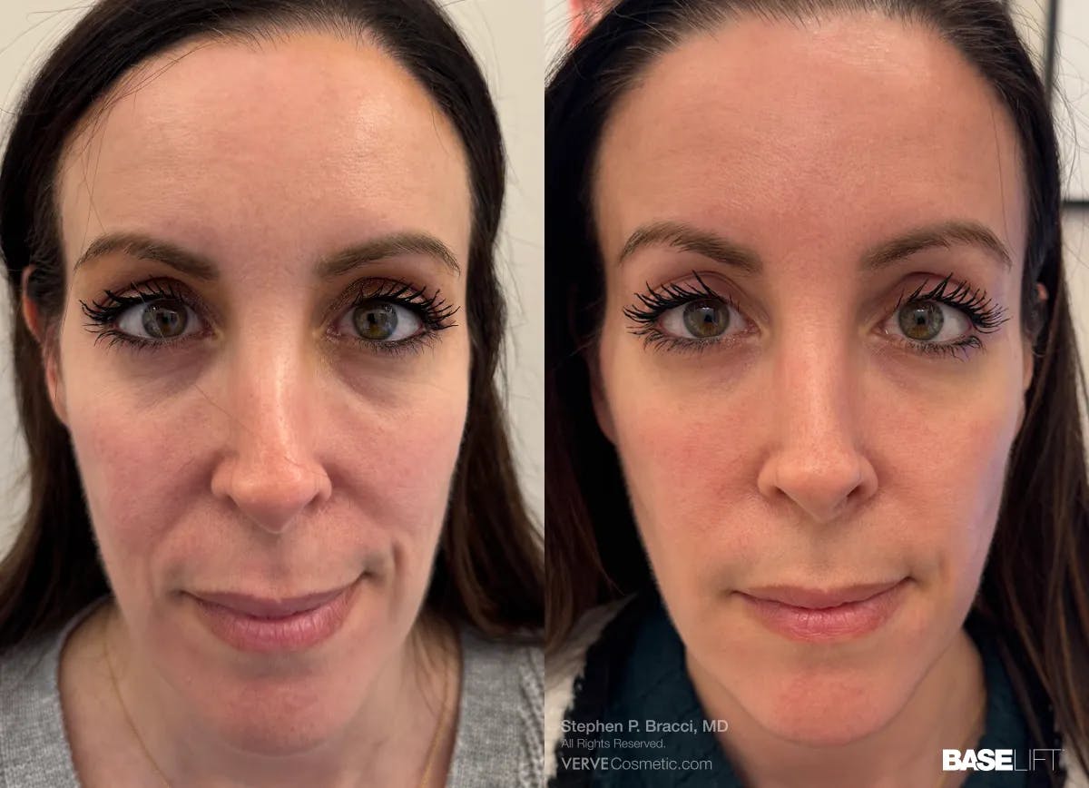 Baselift™ Before & After Gallery - Patient 191757 - Image 1