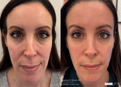 Baselift™ Before & After Gallery - Patient 191757 - Image 1