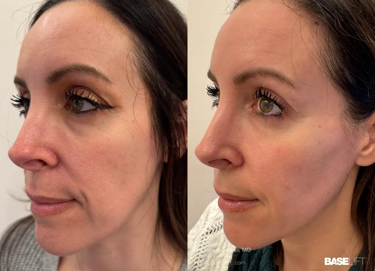 Baselift™ Before & After Gallery - Patient 191757 - Image 2