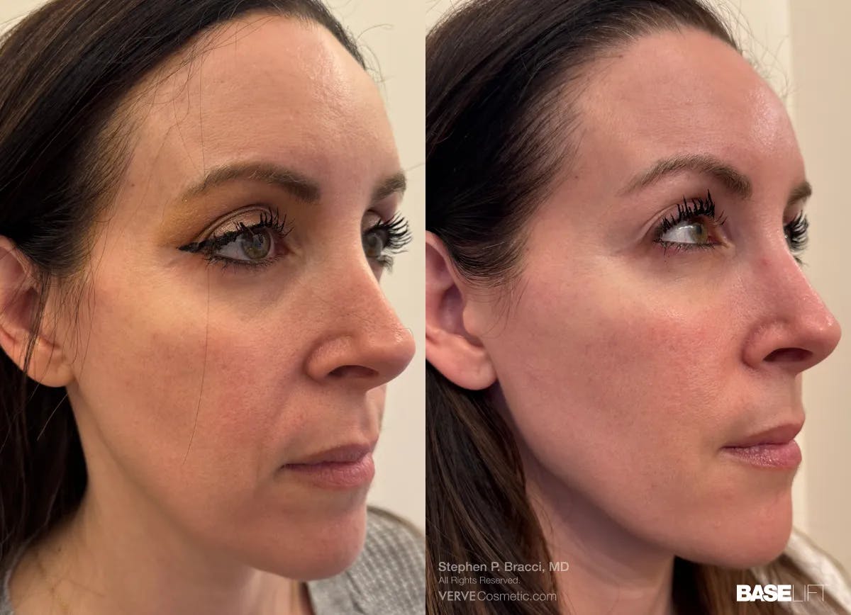 Baselift™ Before & After Gallery - Patient 191757 - Image 3