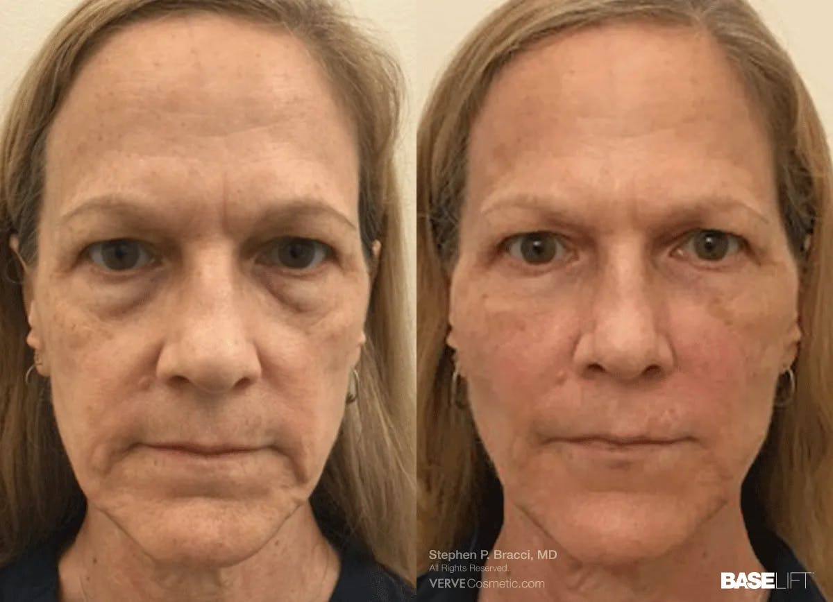 Baselift™ Before & After Gallery - Patient 454733 - Image 1