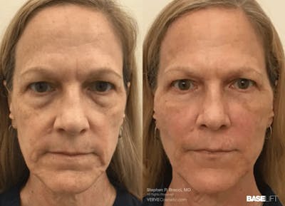 Baselift™ Before & After Gallery - Patient 454733 - Image 1