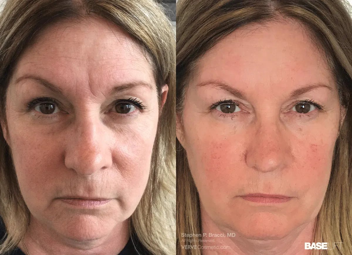 Baselift™ Before & After Gallery - Patient 335143 - Image 1