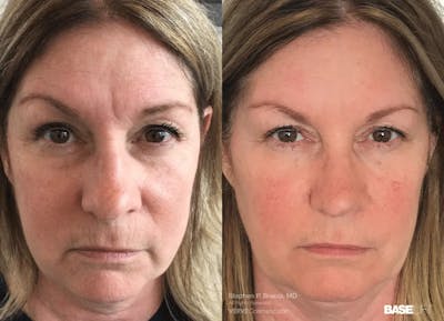 Baselift™ Before & After Gallery - Patient 335143 - Image 1