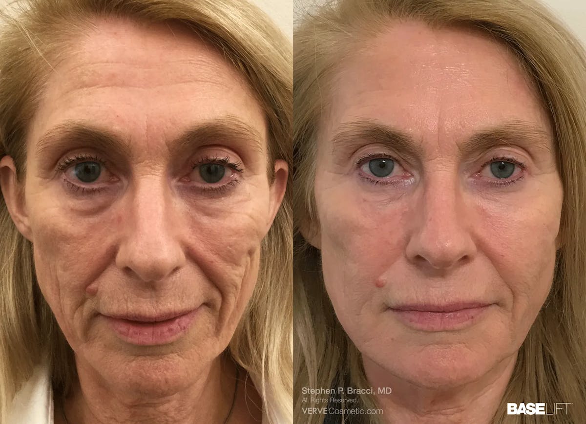 Baselift™ Before & After Gallery - Patient 239062 - Image 1