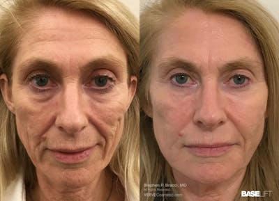 Baselift™ Before & After Gallery - Patient 239062 - Image 1