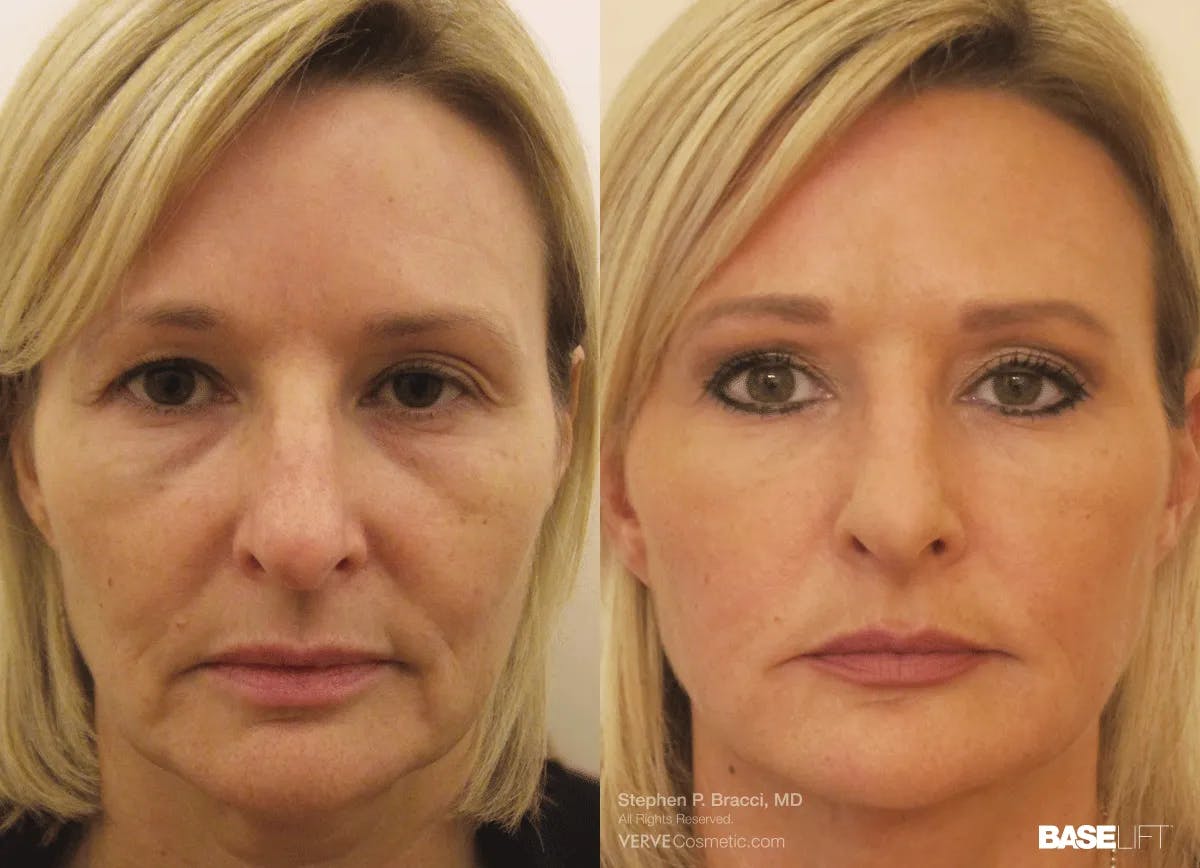 Baselift™ Before & After Gallery - Patient 330509 - Image 1
