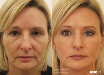Baselift™ Before & After Gallery - Patient 330509 - Image 1