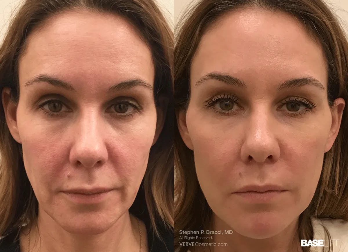 Baselift™ Before & After Gallery - Patient 173372 - Image 1