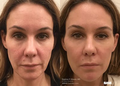 Baselift™ Before & After Gallery - Patient 173372 - Image 1