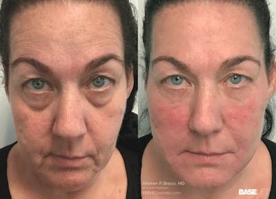 Baselift™ Before & After Gallery - Patient 604189 - Image 1