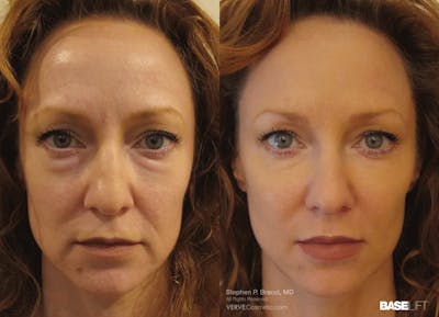 Baselift™ Before & After Gallery - Patient 344793 - Image 1