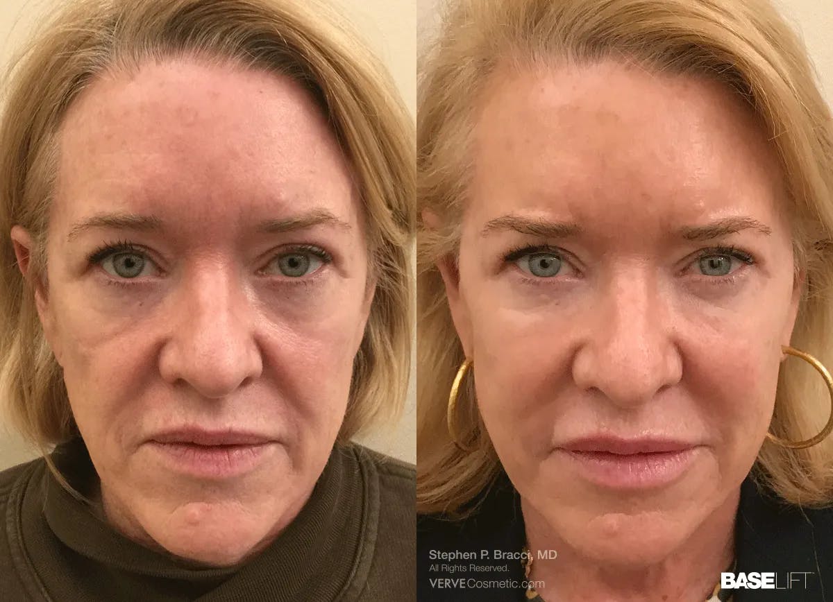 Baselift™ Before & After Gallery - Patient 100782 - Image 1