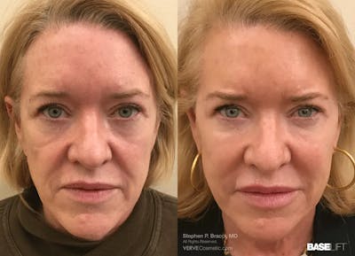 Baselift™ Before & After Gallery - Patient 100782 - Image 1