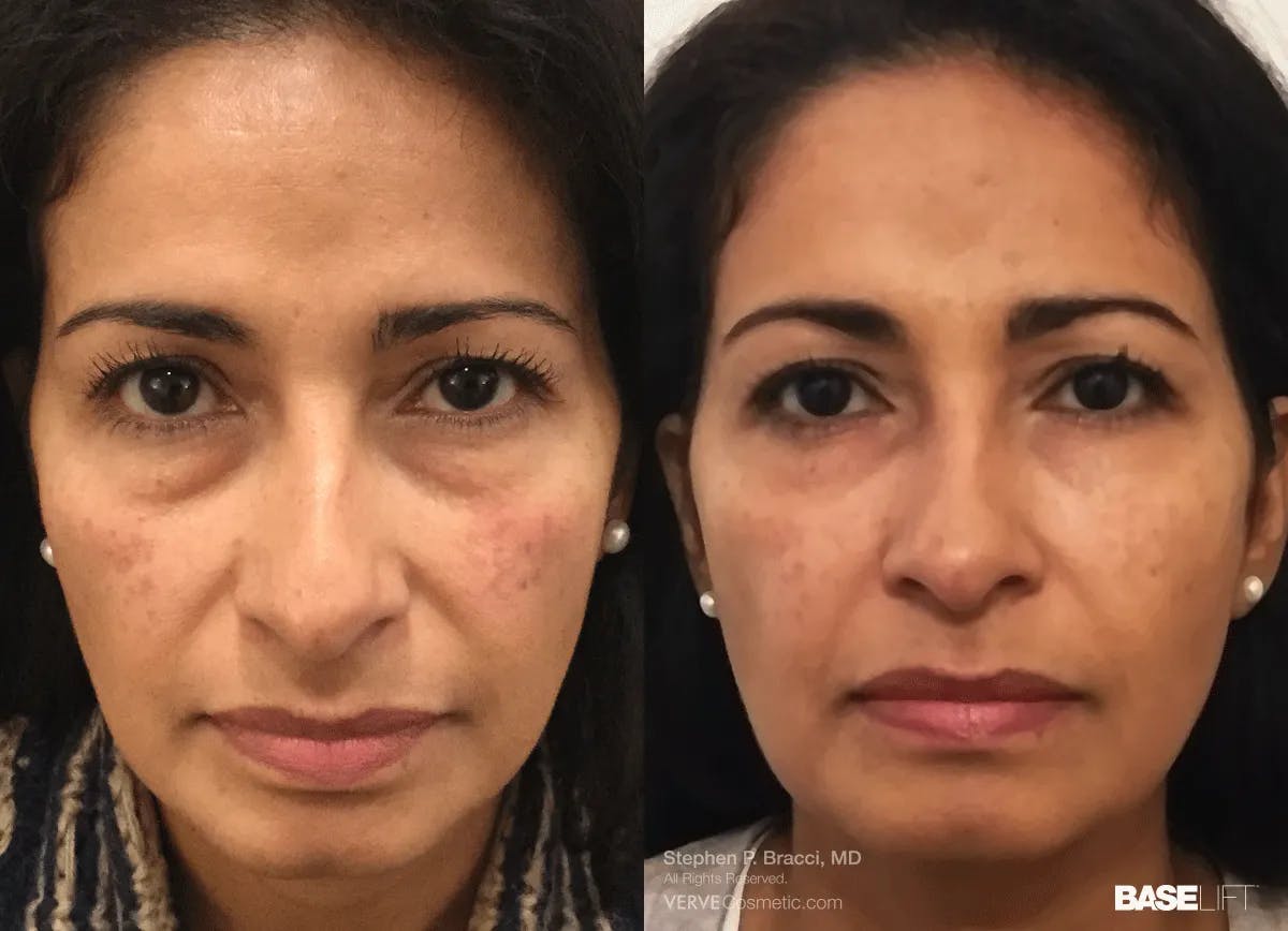 Baselift™ Before & After Gallery - Patient 419866 - Image 1