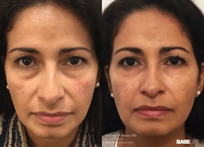 Baselift™ Before & After Gallery - Patient 419866 - Image 1
