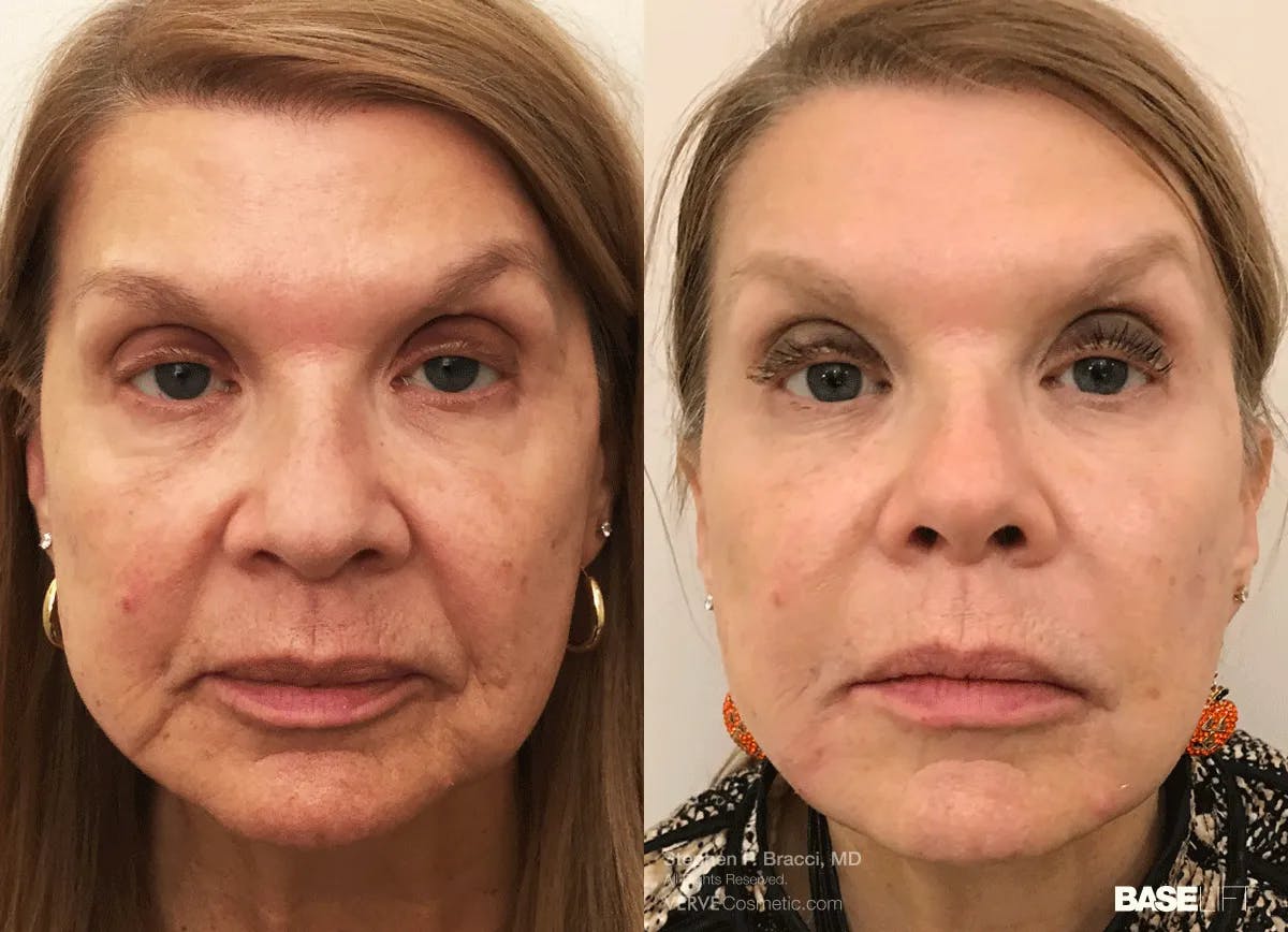 Baselift™ Before & After Gallery - Patient 428519 - Image 1