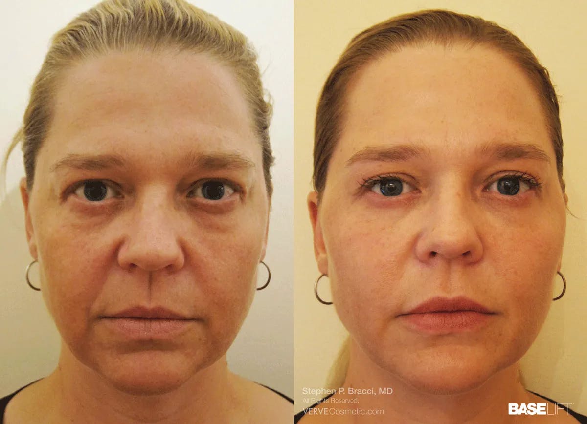 Baselift™ Before & After Gallery - Patient 174443 - Image 1