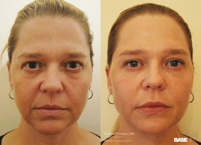 Baselift™ Before & After Gallery - Patient 174443 - Image 1
