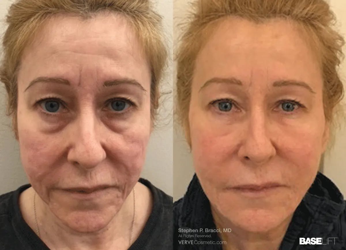 Baselift™ Before & After Gallery - Patient 263004 - Image 1