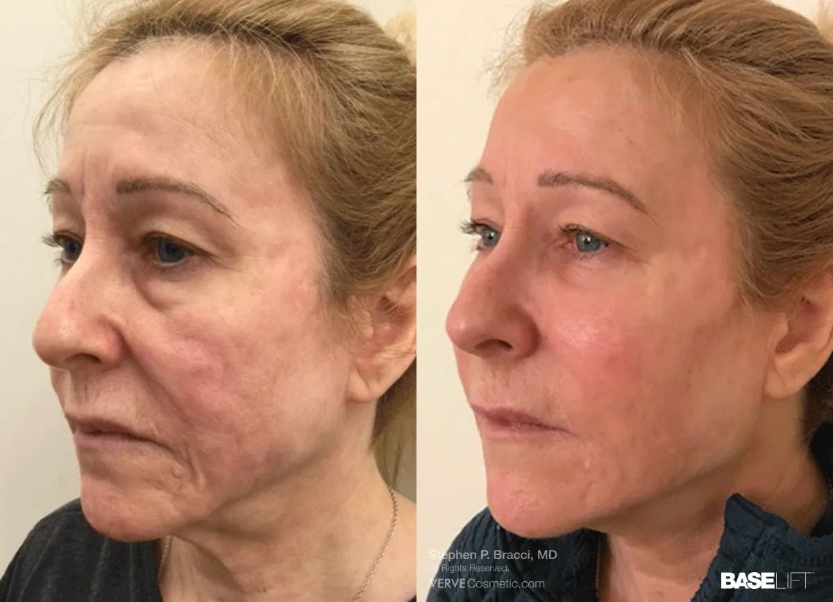 Baselift™ Before & After Gallery - Patient 263004 - Image 2