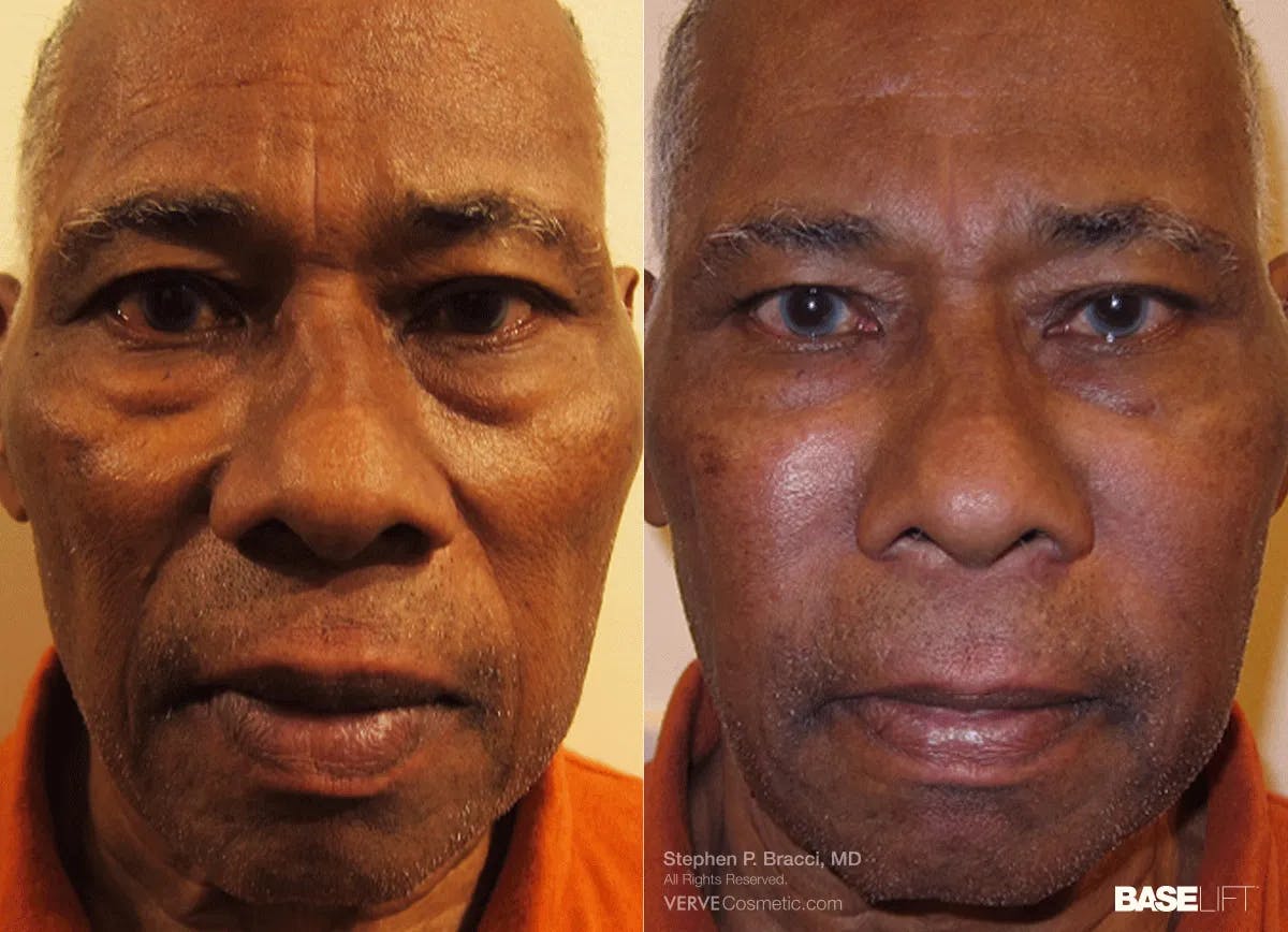 Baselift™ Before & After Gallery - Patient 372471 - Image 1