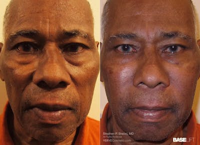 Baselift™ Before & After Gallery - Patient 372471 - Image 1