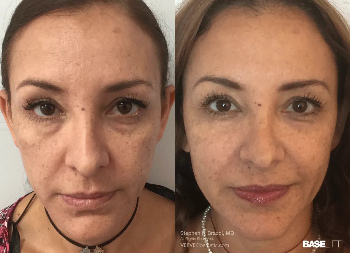 Baselift™ Before & After Gallery - Patient 499129 - Image 1