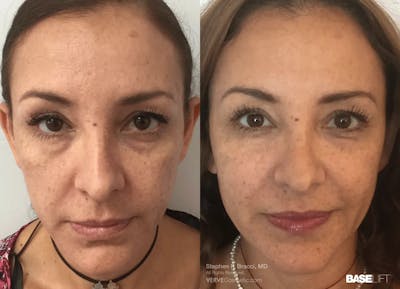 Baselift™ Before & After Gallery - Patient 499129 - Image 1
