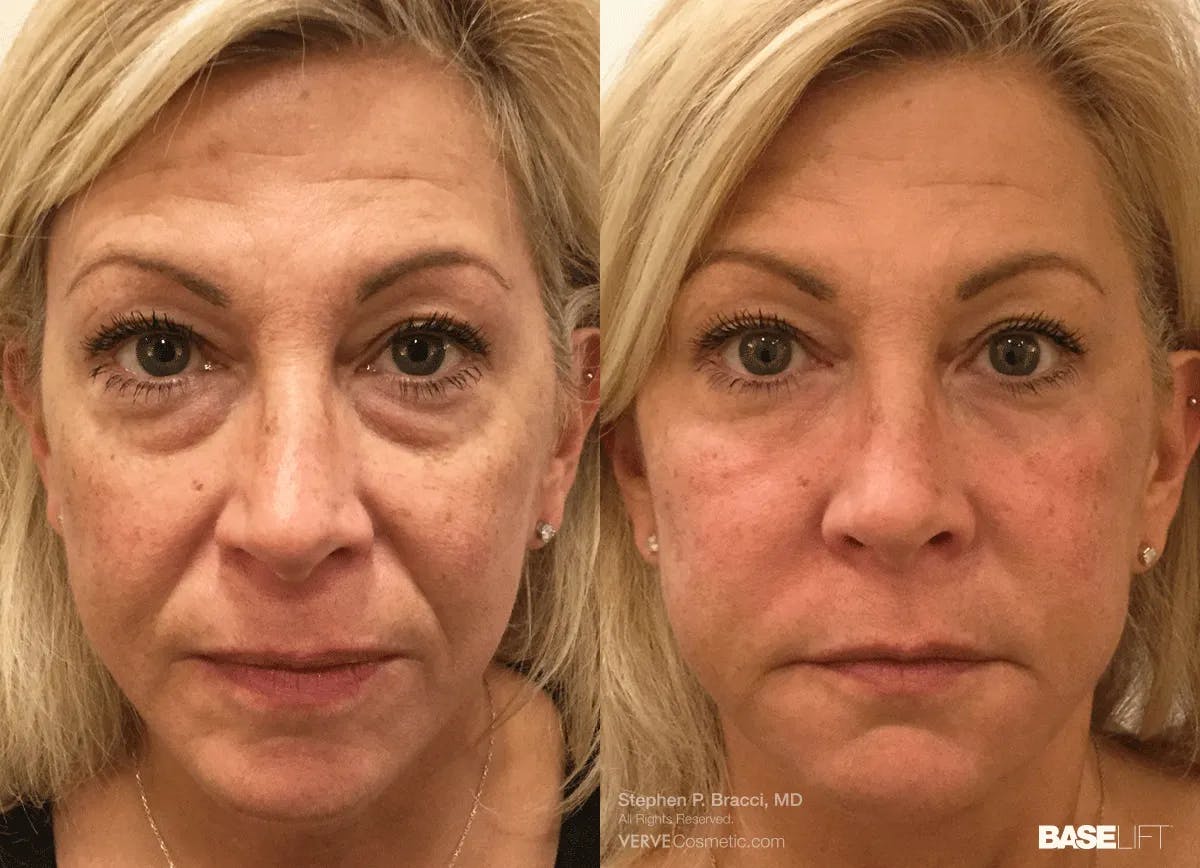 Baselift™ Before & After Gallery - Patient 168886 - Image 1