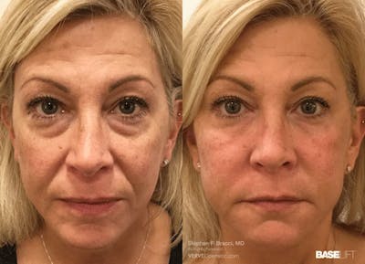 Baselift™ Before & After Gallery - Patient 168886 - Image 1